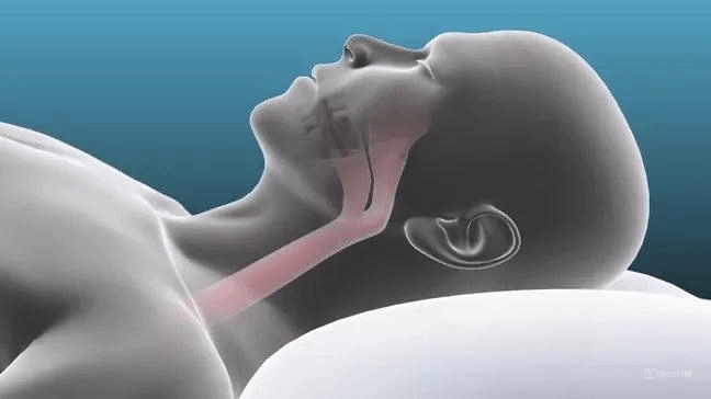 ZQuiet Anti - Snoring Mouthpiece 2 - Size Starter Pack - Mi tienda